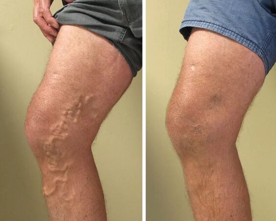 Varizes antes e depois do tratamento